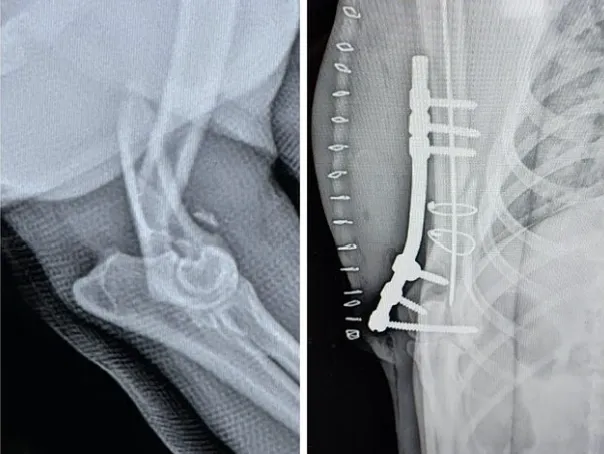 Side-by-side X-rays of a bone fracture before and after surgical repair with a metal plate and screws.